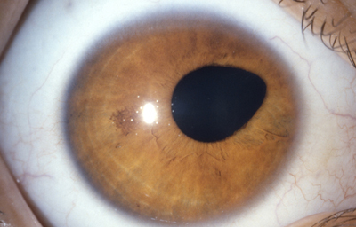 Coloboma