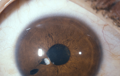 Coloboma