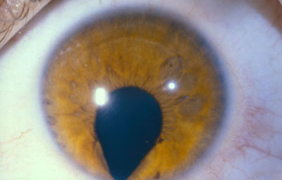 Coloboma