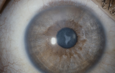 Foto 7 Foto del OD a los 6 meses mostrando edema a las 12 y despigmentación del Iris en 360o
