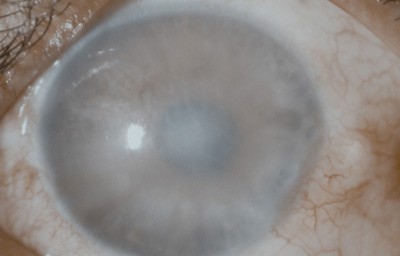 Foto 12 - Foto con edema total de la córnea, despigmentación del Iris y opacidad subcapsular anterior