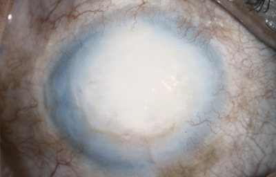 Foto 19 - Leucoma denso con bullas y vaso estromal profundo a las 6