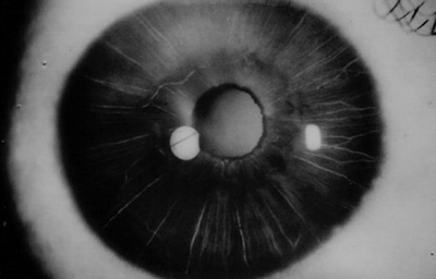 Foto 6 Angiografìa a los 6 meses con Exudación en el Iris