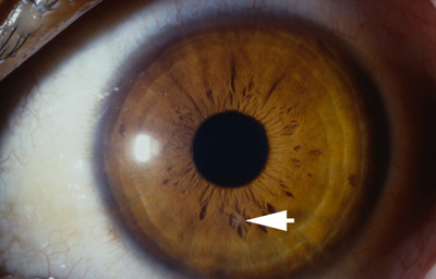Foto 20 - Leucoma puntiforme debajo del reborde pupilar con aguijón